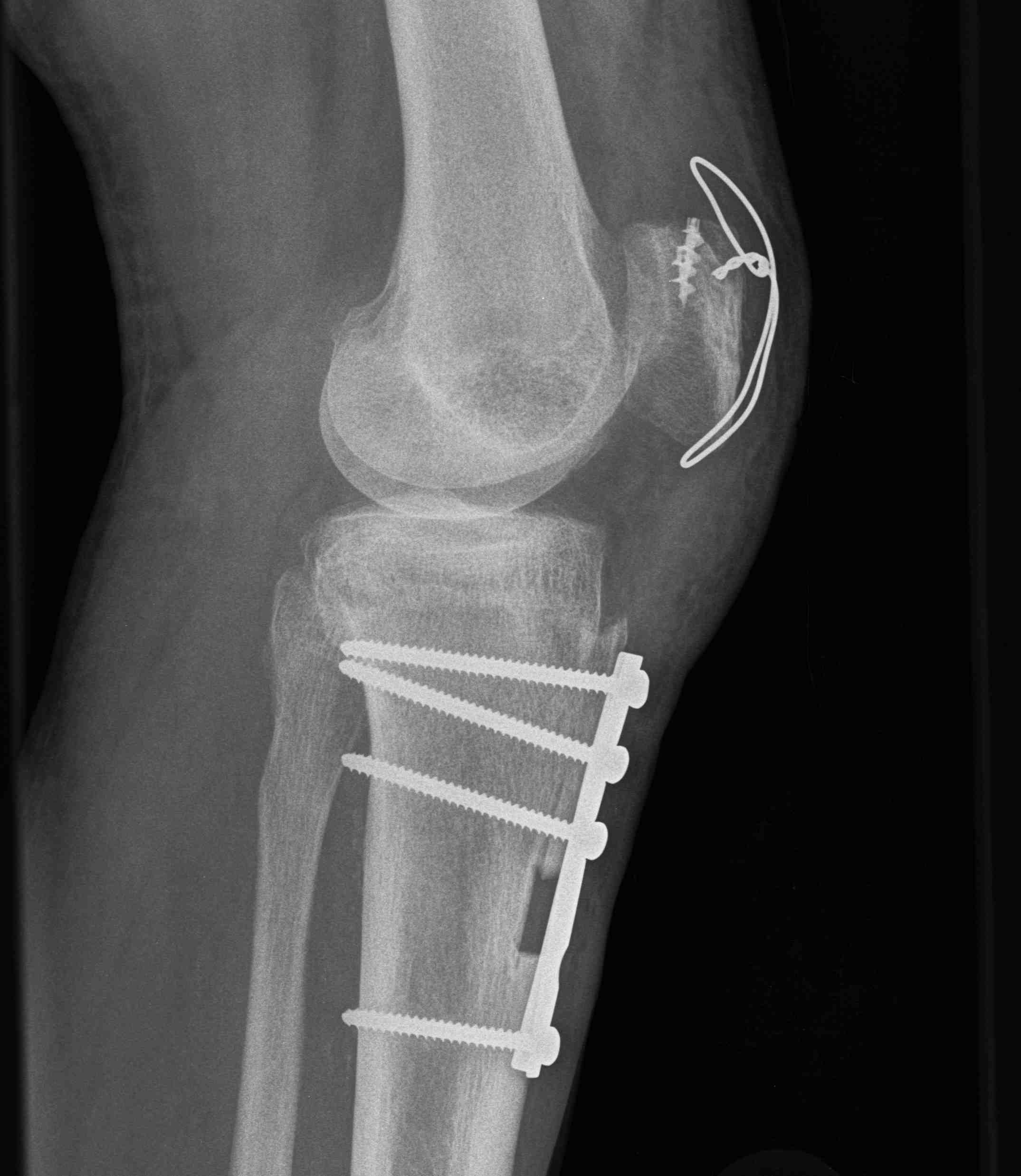 Revision Quadriceps Repair with Tibial Tuberosity Osteotomy